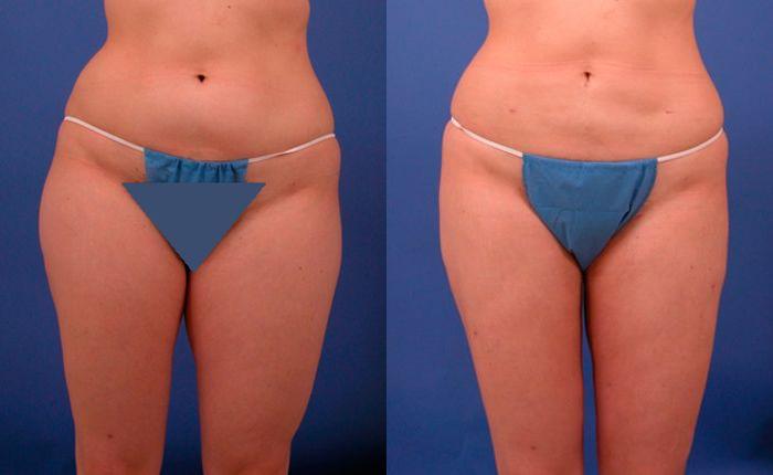 Hidden Liposuction  Before & After Gallery - Patient 210403 - Image 1