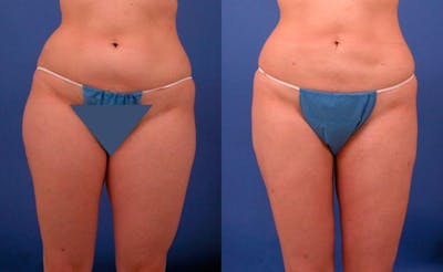 Liposuction Before & After Gallery - Patient 372027 - Image 1