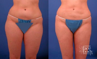 Hidden Liposuction  Before & After Gallery - Patient 210403 - Image 1