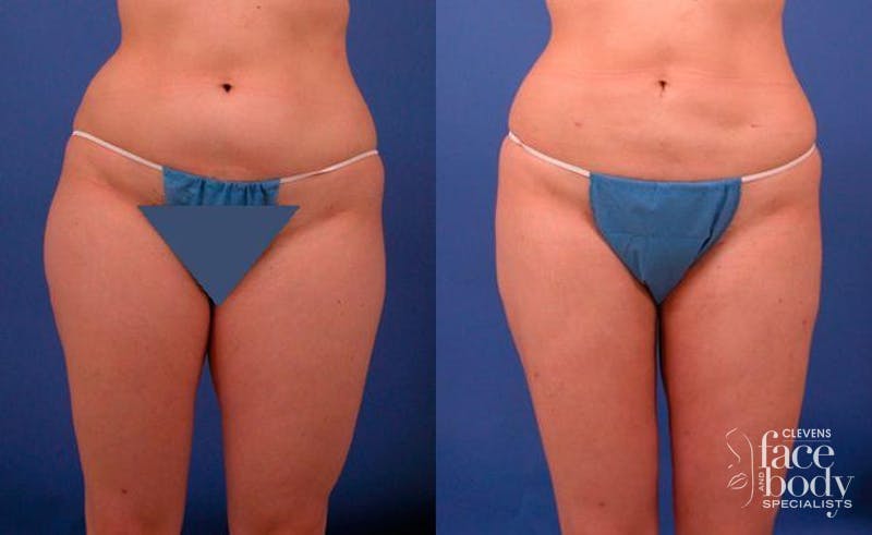 Hidden Liposuction  Before & After Gallery - Patient 210403 - Image 1
