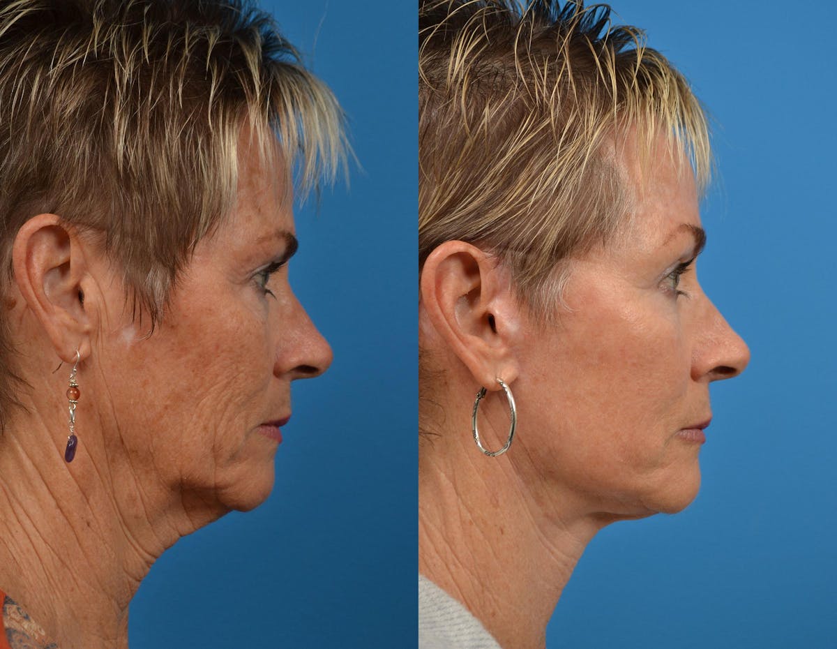 Facelift Before & After Gallery - Patient 122406063 - Image 5
