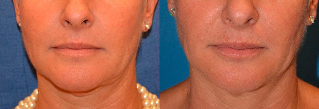 Lip Fillers Before & After Gallery - Patient 122406062 - Image 1