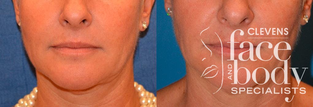 Lip Augmentation