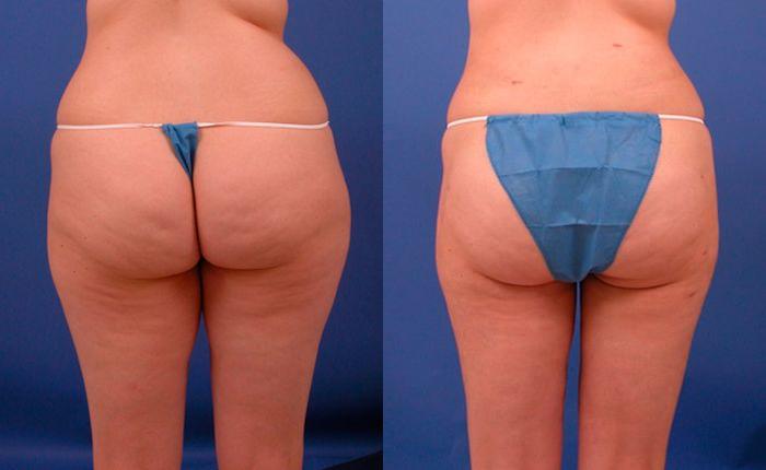 Hidden Liposuction  Before & After Gallery - Patient 210403 - Image 2