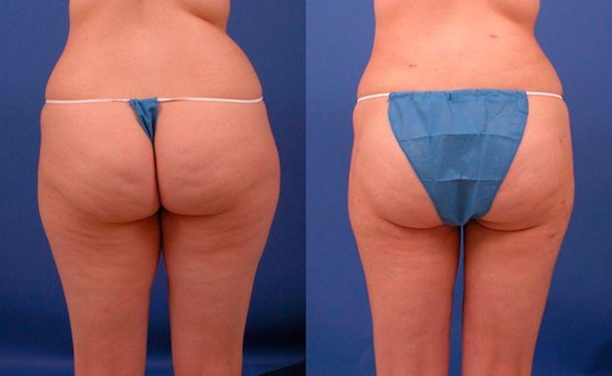 Liposuction Before & After Gallery - Patient 372027 - Image 2