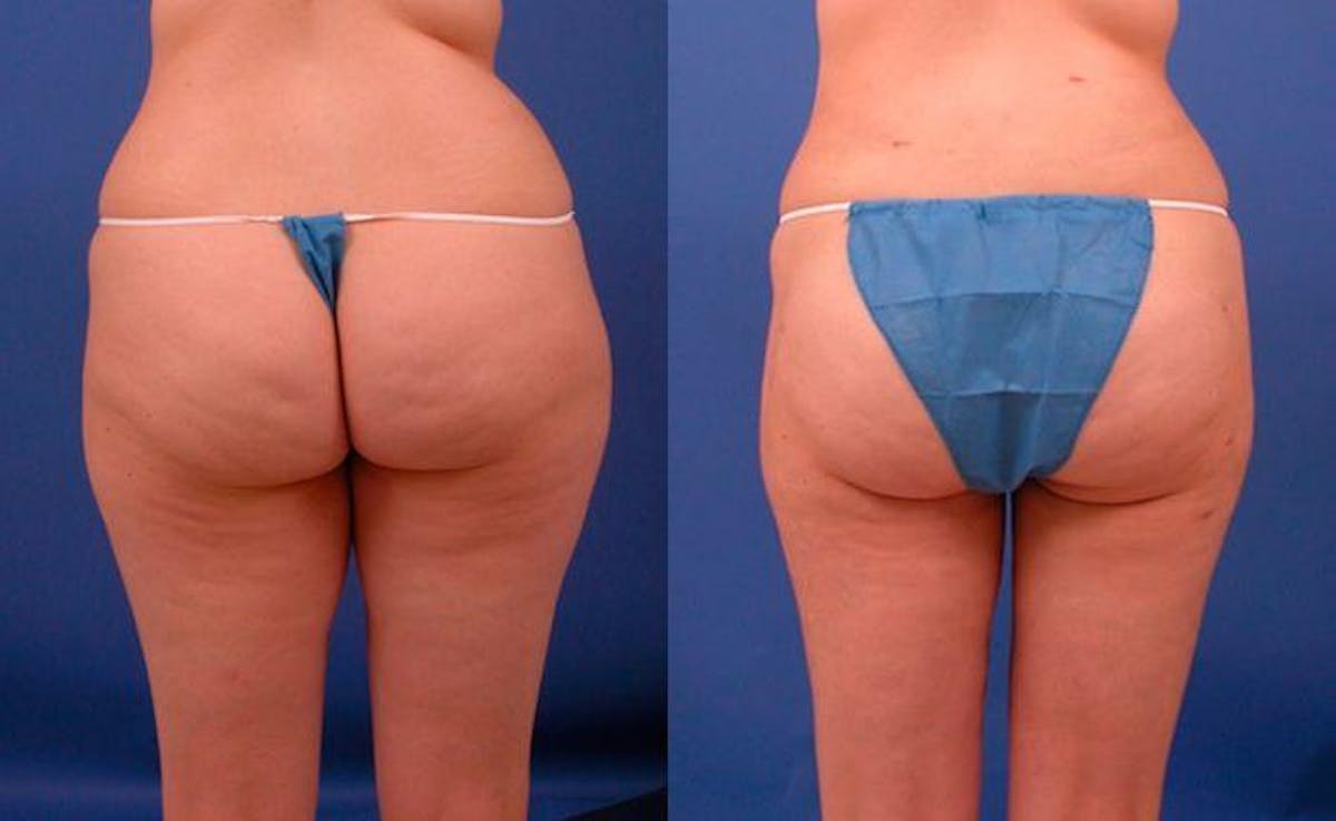 Hidden Liposuction  Before & After Gallery - Patient 210403 - Image 2