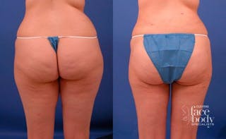 Hidden Liposuction  Before & After Gallery - Patient 210403 - Image 2
