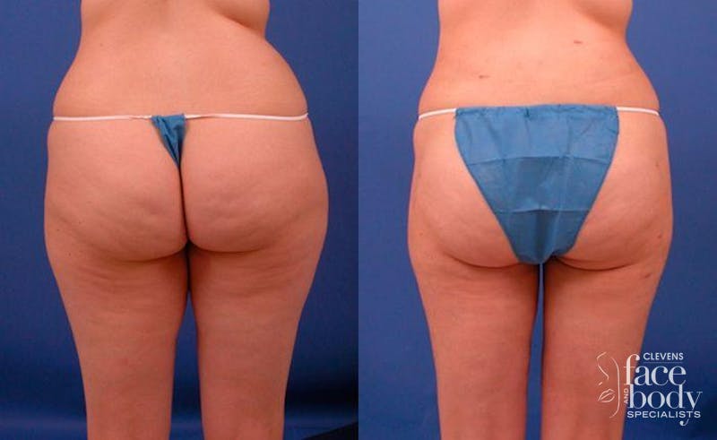 Hidden Liposuction  Before & After Gallery - Patient 210403 - Image 2