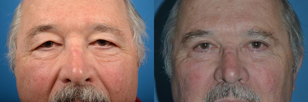 Eyelid Surgery Before & After Gallery - Patient 122406065 - Image 1