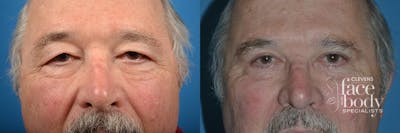 Eyelid Surgery Before & After Gallery - Patient 253782 - Image 1