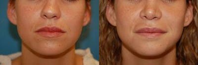 Lip Fillers Before & After Gallery - Patient 122406066 - Image 1