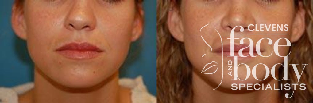 Lip Augmentation
