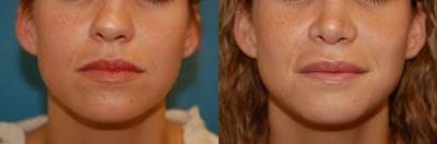 Lip Fillers Before & After Gallery - Patient 122406066 - Image 1