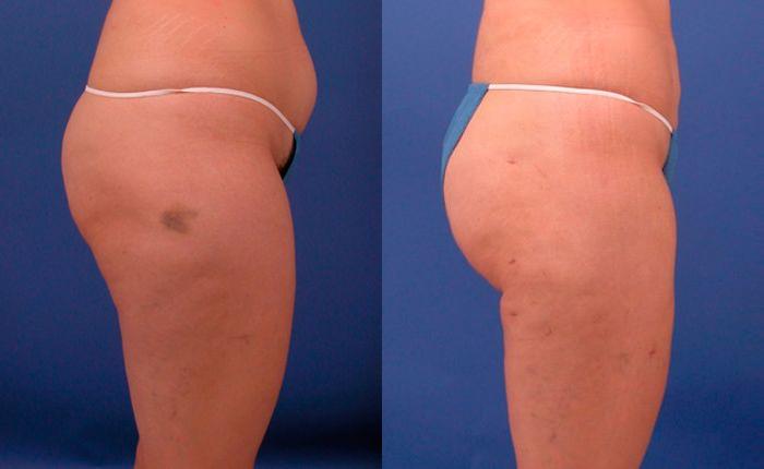Hidden Liposuction  Before & After Gallery - Patient 210403 - Image 3
