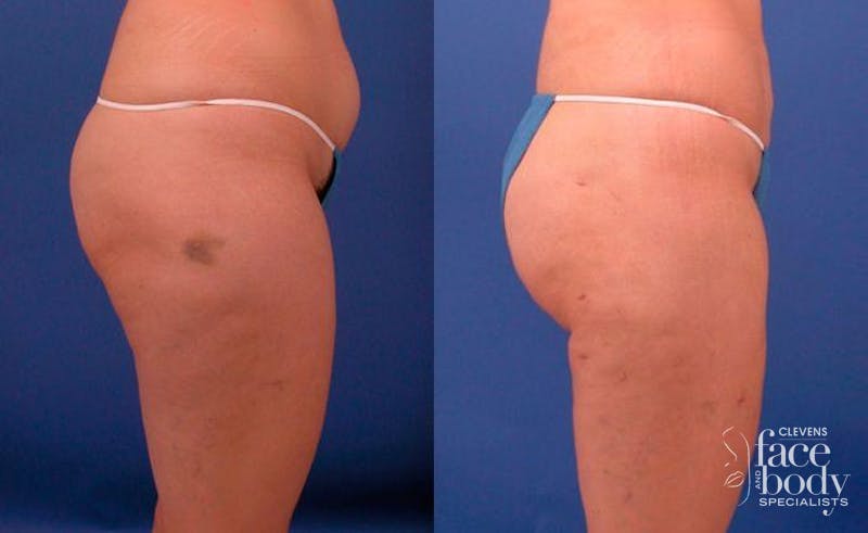 Hidden Liposuction  Before & After Gallery - Patient 210403 - Image 3