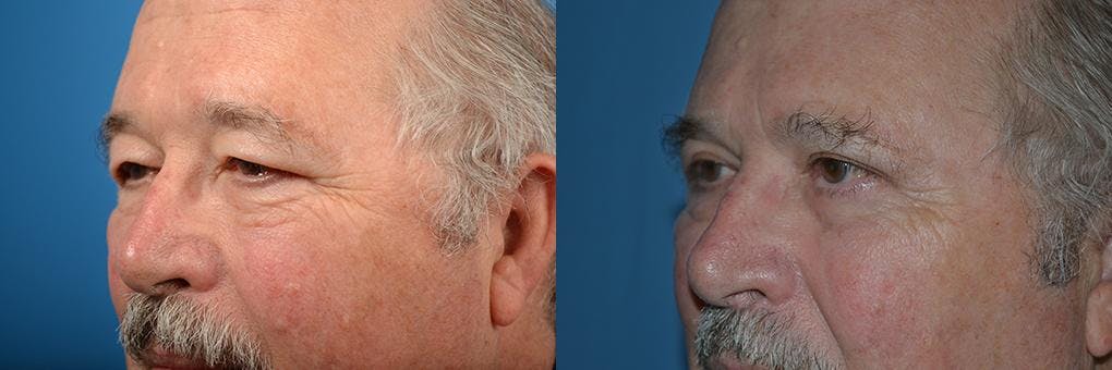 Eyelid Surgery Before & After Gallery - Patient 122406065 - Image 2