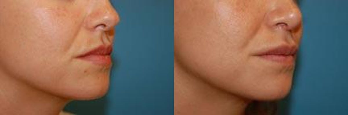 Lip Fillers Before & After Gallery - Patient 122406066 - Image 2
