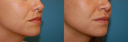 Lip Fillers Before & After Gallery - Patient 122406066 - Image 2