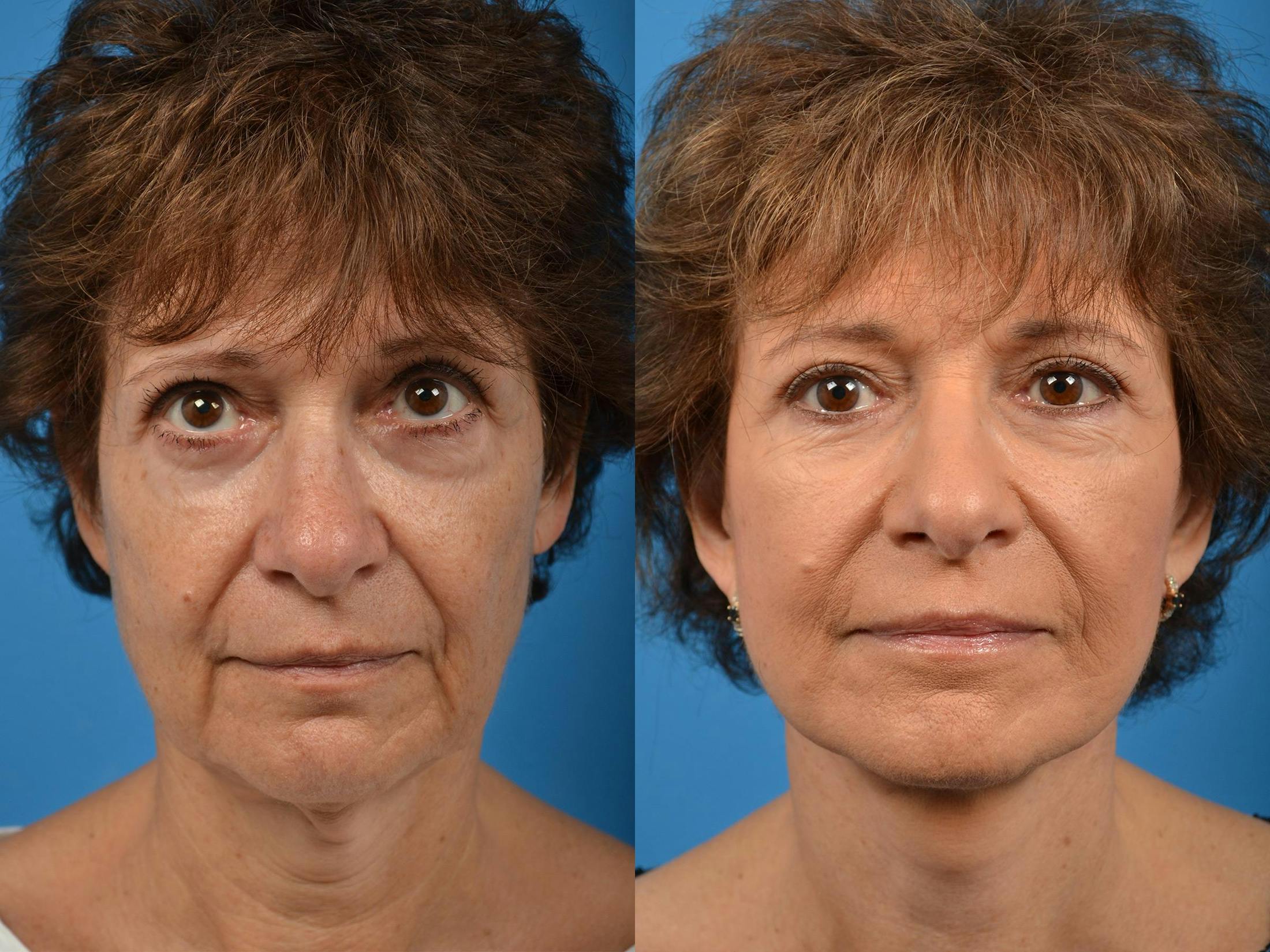 Facelift Before & After Gallery - Patient 122406078 - Image 1