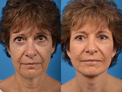 Facelift Before & After Gallery - Patient 122406078 - Image 1