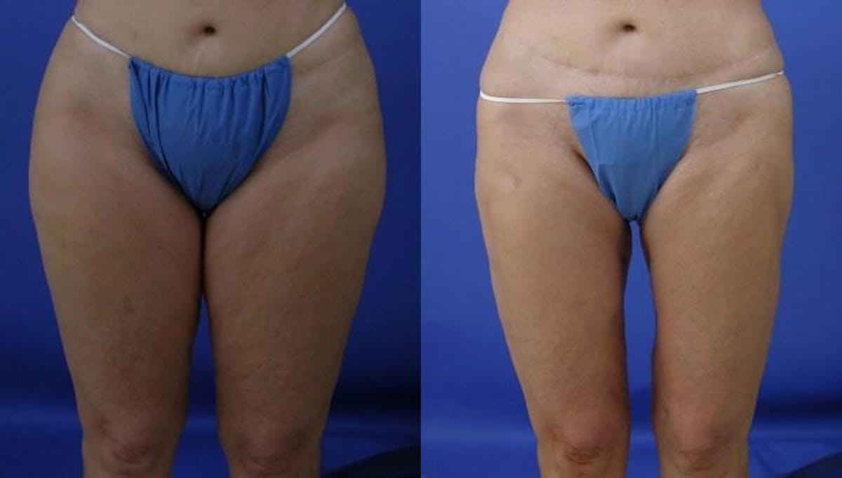 Liposuction Before & After Gallery - Patient 230548 - Image 1