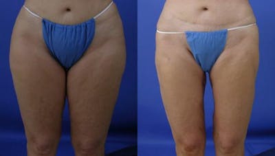 Liposuction Before & After Gallery - Patient 230548 - Image 1
