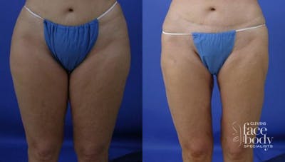 Hidden Liposuction  Before & After Gallery - Patient 874846 - Image 1