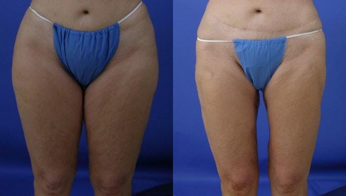 Liponique Body Contouring Before & After Gallery - Patient 122406067 - Image 1