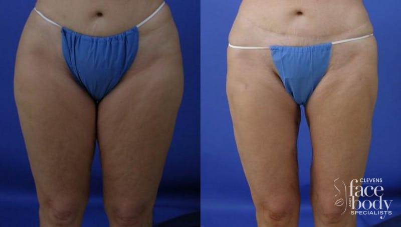 Hidden Liposuction Before & After Gallery - Patient 874846 - Image 1