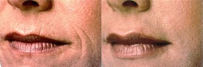 Lip Fillers Before & After Gallery - Patient 122406068 - Image 1