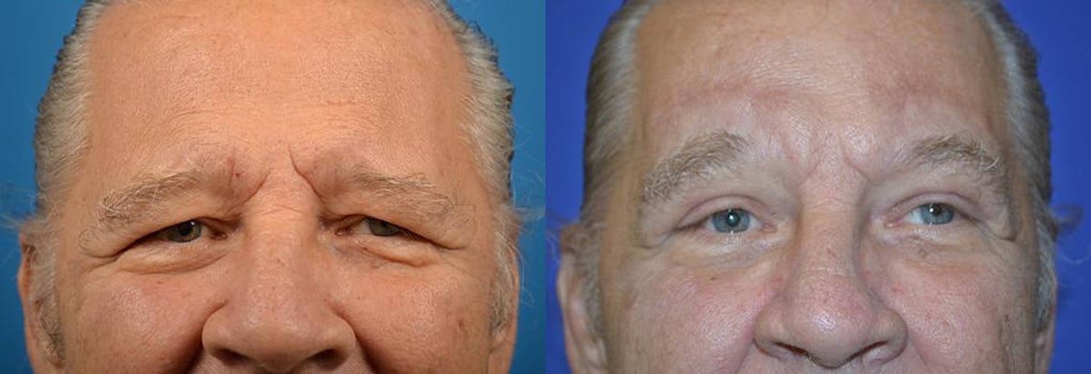 Eyelid Surgery Before & After Gallery - Patient 122406070 - Image 1