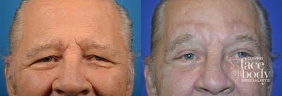 Eyelid Surgery Before & After Gallery - Patient 675894 - Image 1