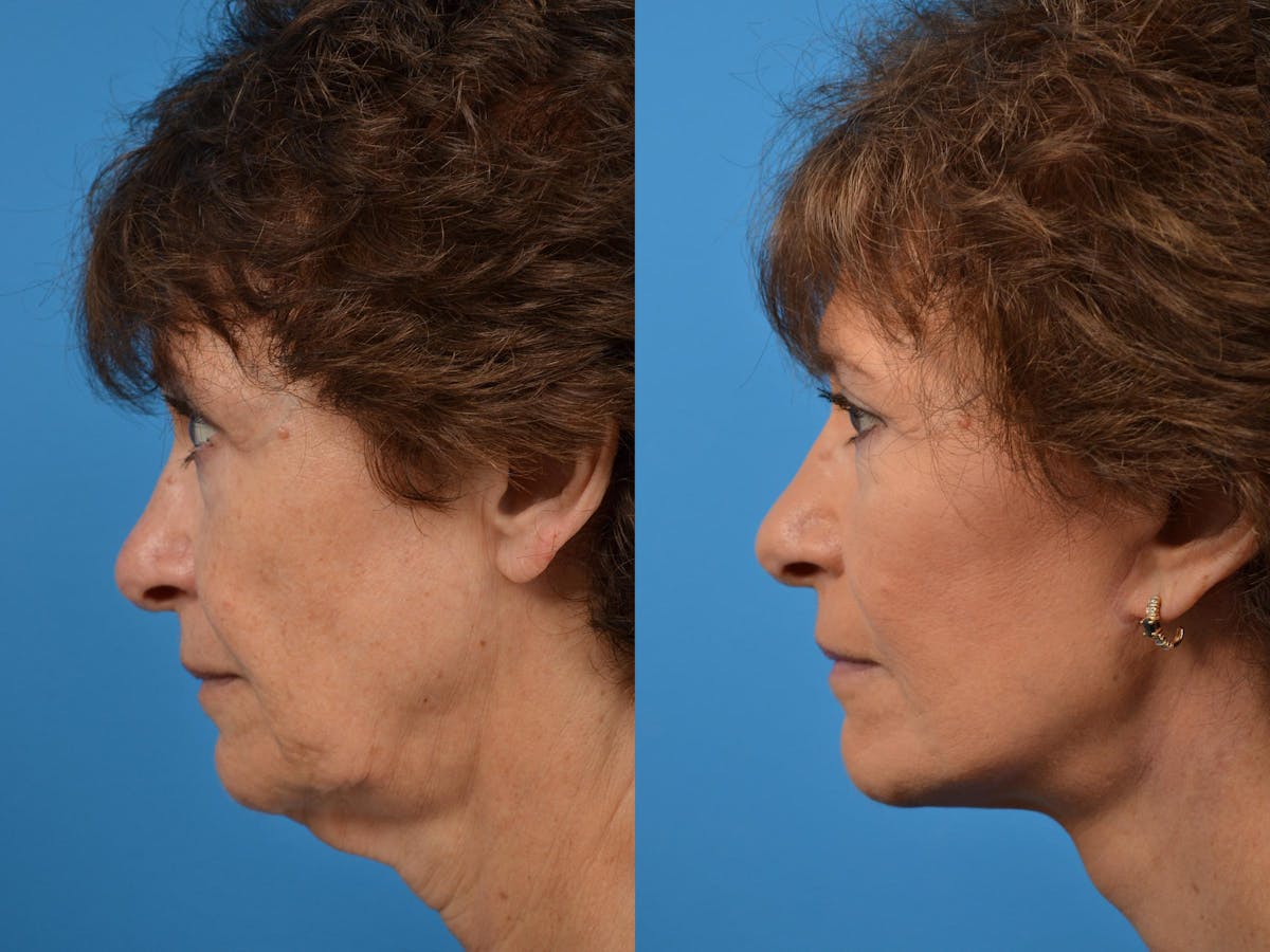 Facelift Before & After Gallery - Patient 122406078 - Image 2