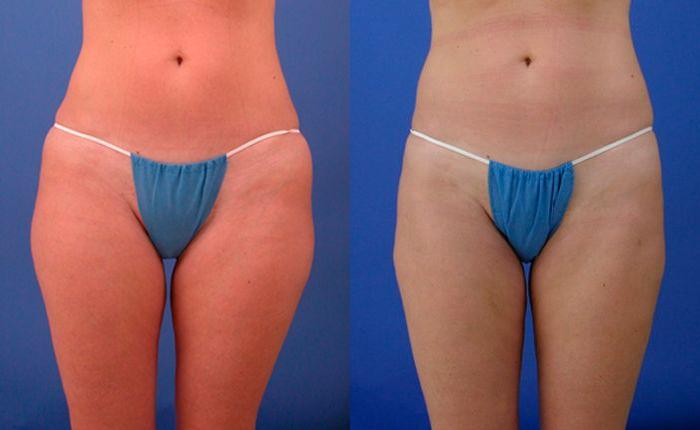 Hidden Liposuction  Before & After Gallery - Patient 208701 - Image 1