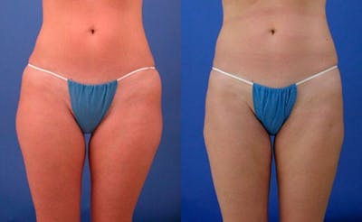 Liposuction Before & After Gallery - Patient 322064 - Image 1