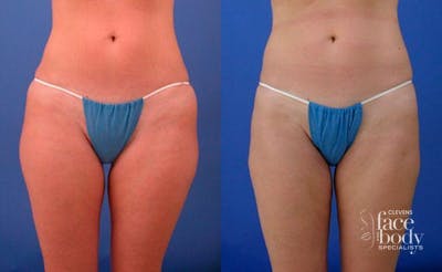 Hidden Liposuction  Before & After Gallery - Patient 208701 - Image 1