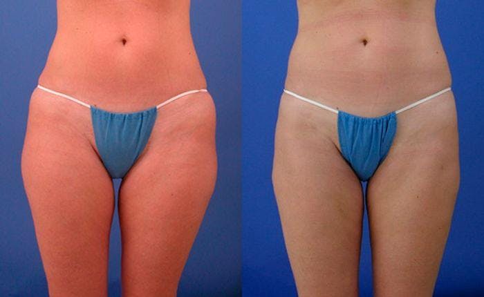 Liponique Body Contouring Before & After Gallery - Patient 122406072 - Image 1