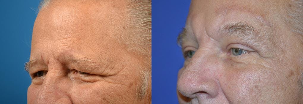 Eyelid Surgery Before & After Gallery - Patient 122406070 - Image 2
