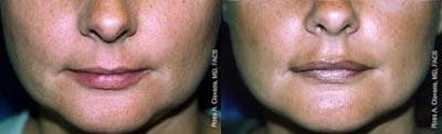 Lip Fillers Before & After Gallery - Patient 122406069 - Image 1