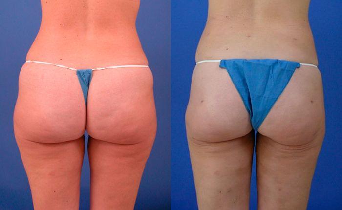 Hidden Liposuction  Before & After Gallery - Patient 208701 - Image 2