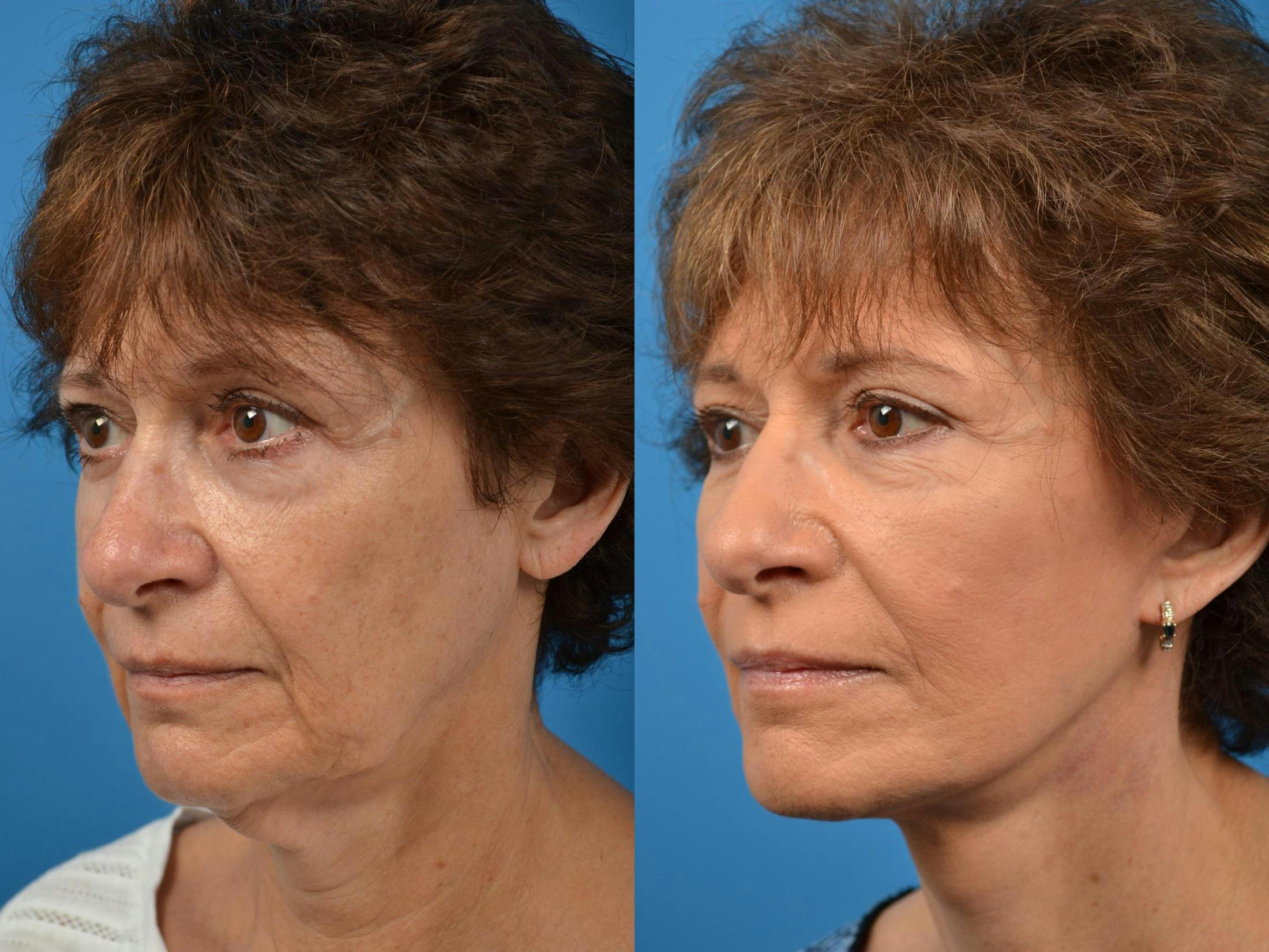 Facelift Before & After Gallery - Patient 122406078 - Image 3