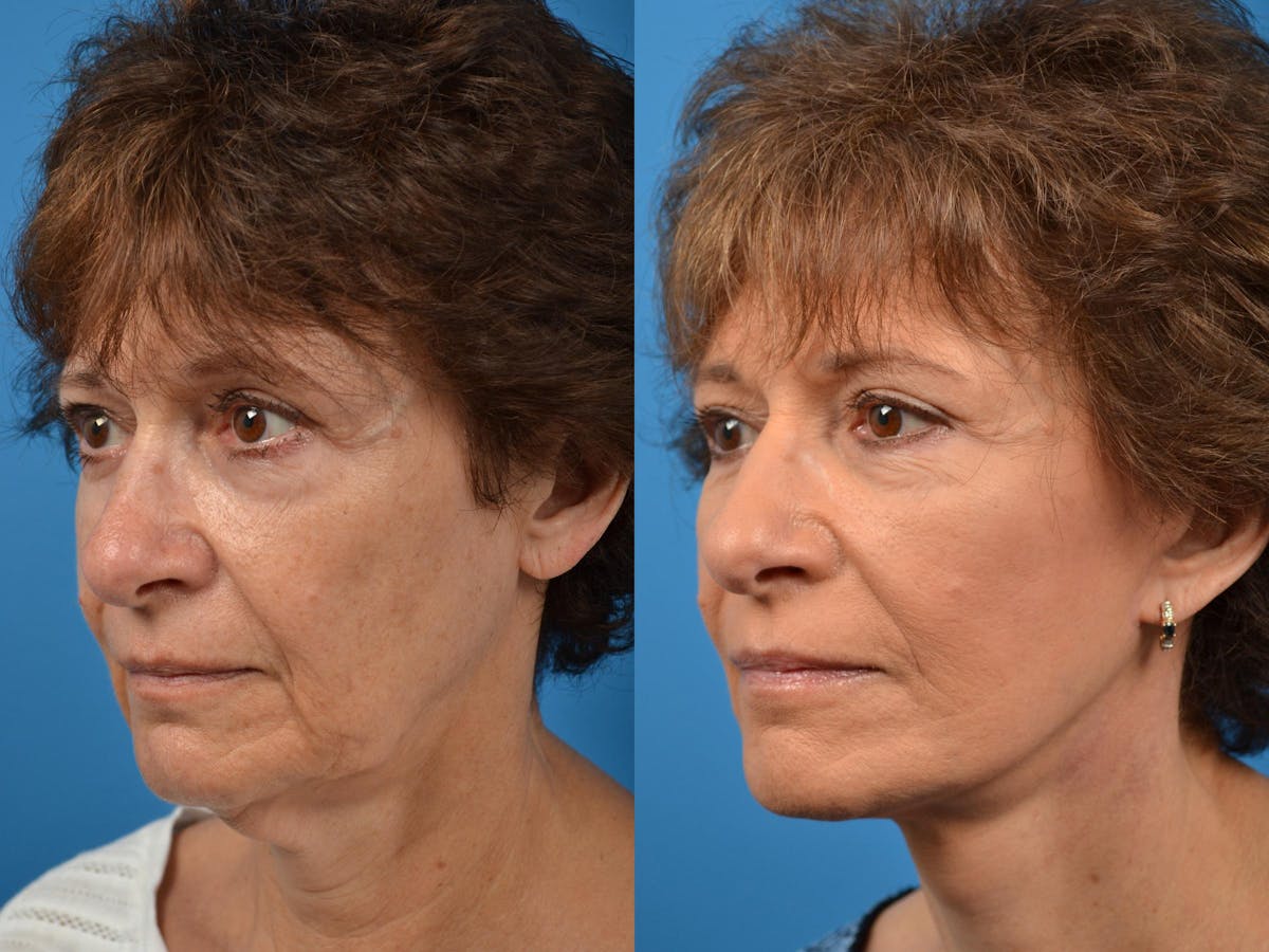 Facelift Before & After Gallery - Patient 122406078 - Image 3