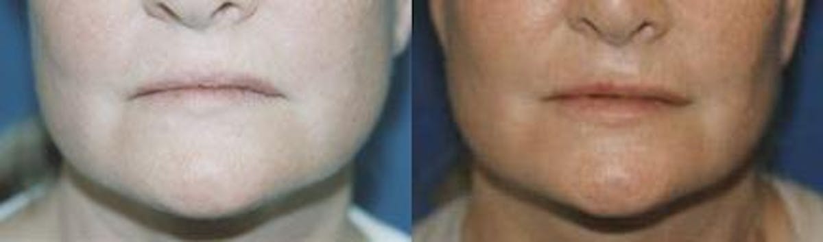 Lip Fillers Before & After Gallery - Patient 122406073 - Image 1