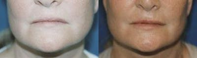 Lip Fillers Before & After Gallery - Patient 122406073 - Image 1