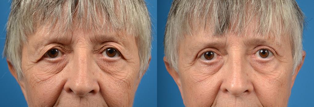 Eyelid Surgery Before & After Gallery - Patient 179660 - Image 1