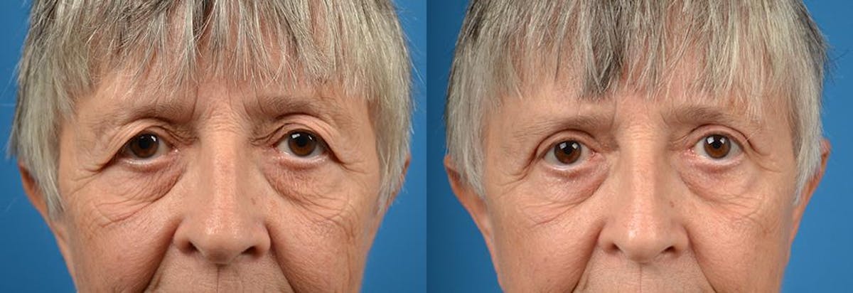 Eyelid Surgery Before & After Gallery - Patient 122406075 - Image 1