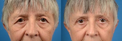 Eyelid Surgery Before & After Gallery - Patient 122406075 - Image 1