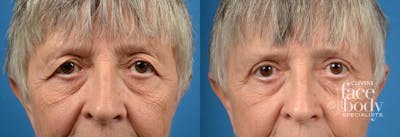 Eyelid Surgery Before & After Gallery - Patient 179660 - Image 1