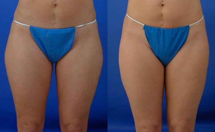 Hidden Liposuction  Before & After Gallery - Patient 141370 - Image 1