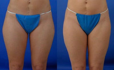 Liposuction Before & After Gallery - Patient 282201 - Image 1
